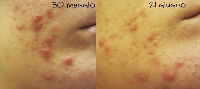 risultati bava lumaca acne