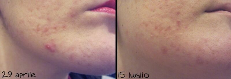 effaclar-duo-plus-funziona